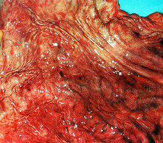 Для проверки своей гипотезы о связи бактерии Helicobacter pylori с развитием язвенной болезни, австралиец Барри Маршалл провёл на себе эксперимент, «заработав» гастрит. Фото 2 