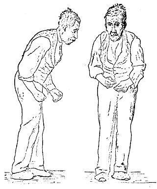 Симптомы болезни Паркинсона, шизофрении, эпилепсии и аутизма предположительно имеют схожую природу. Фото 1 