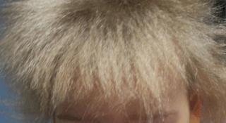 Стёпка-растрёпка страдал, возможно, редкой мутацией. Фото 2 