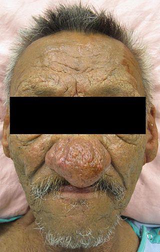 Одним из акцентов картины Доменико Гирландайо является редкое заболевание. Фото 2 