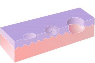 Бактерией Helicobacter pylori, являющейся основной причиной хронического гастрита и язвенной болезни, заражено две трети человечества. Большое красное пятно. Фото 3 